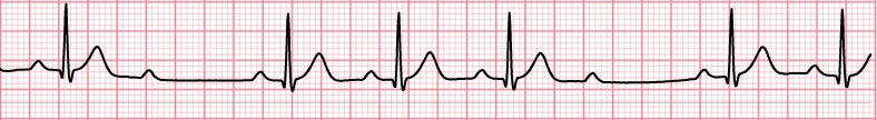 ECG second degree av block, Mobitz 2, narrow qrs, 4:3
