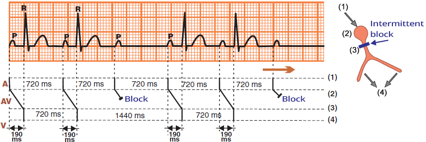 Laddergram, ECG second AV block, Mobitz 2, His bundle block