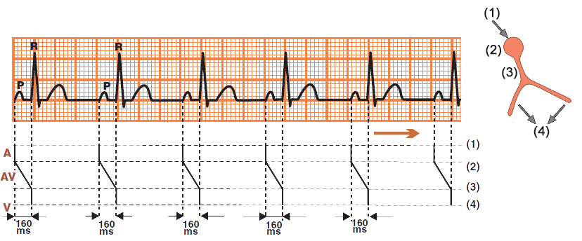 Laddergram with ECG sinus rhythm