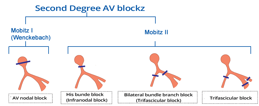 2nd AV block, Mobitz 1 vs. Mobitz 2: His bundle block, Bilateral Bundle Branch block, Trifascicular block