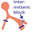 AV block, Mobitz 2, Bifascicular block