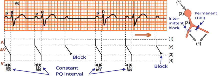 Laddergram, ECG: 2nd AV block, Mobitz II, broad QRS complexes, distal to the Bundle of His