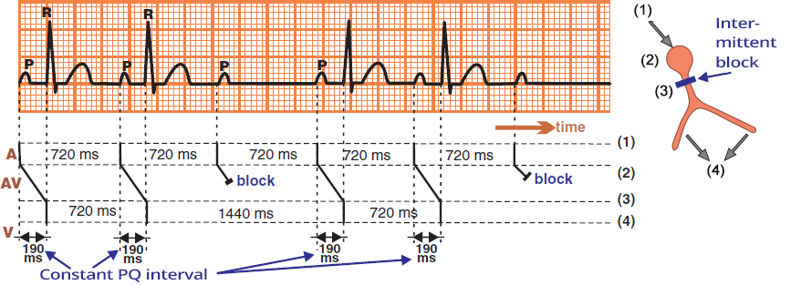 Laddergram, ECG: 2nd AV block, Mobitz II, narrow QRS complexes, His bundle block