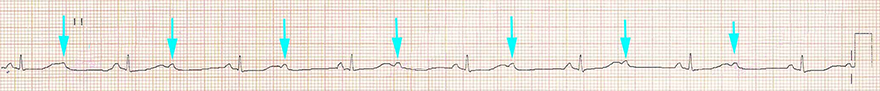 ECG 2nd degree AV block, fixed ratio 2:1
