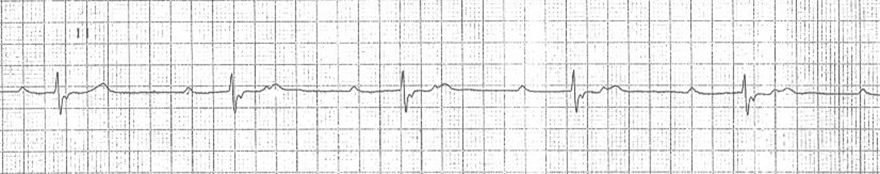 ECG 2nd degree av block ratio 2:1 (P:QRS)