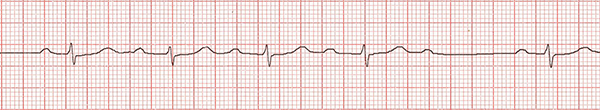 ECG 2nd AV block, Mobitz 1, narrow QRS