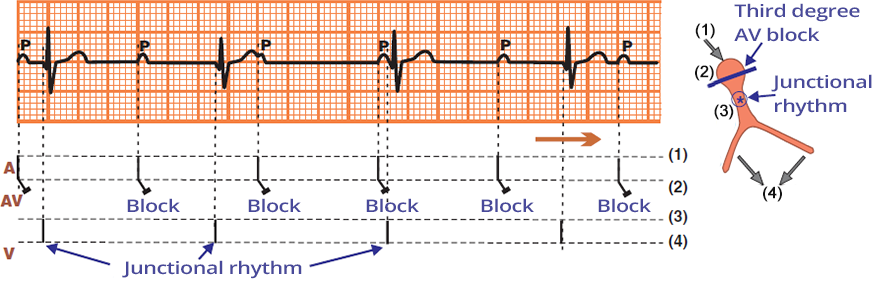 ECG, Laddergram, 3rd degree complete av block, junctional escape rhythm, narrow qrs complexes