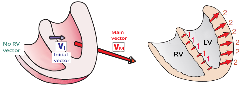 Left bundle branch block (LBBB), sequence of left ventricular depolarization