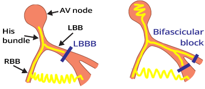 Site of LBBB main trunk, or block of both left fascicles