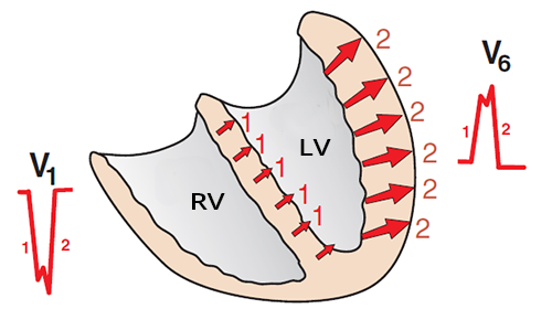 ECG (V1,V6) ventricular vectors, left bundle branch block (LBBB)