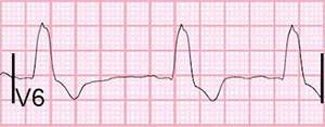 ECG complete Left Bundle Branch Block (LBBB)
