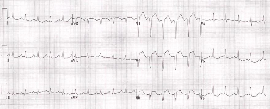 ECG incomplete LBBB, narrow QRS complex, Absence lateral q wave, R peak time greater than 60ms, broad notched slurred R wave
