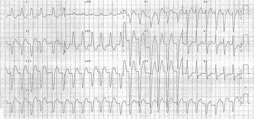 ECG LBBB and atrial fibrillation