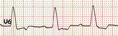 ECG (V6) LBBB monophasic R wave, appropriate discordance
