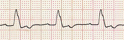 ECG (V6) LBBB, monophasic notched R wave morphology
