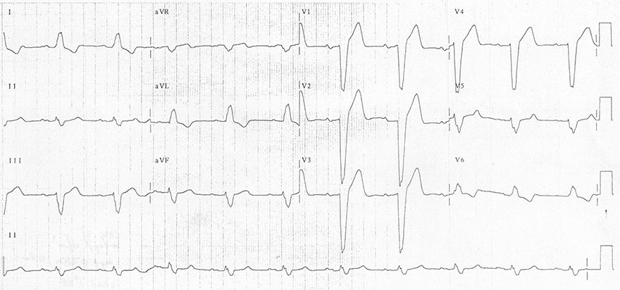 ECG complete LBBB, Dominant R (V6), Deep S (V1), broad QRS