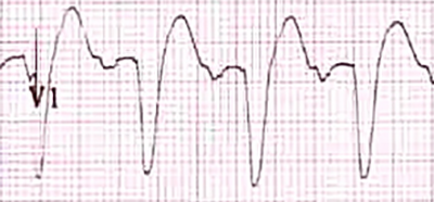 ECG (V1) LBBB Q (QS) morphology