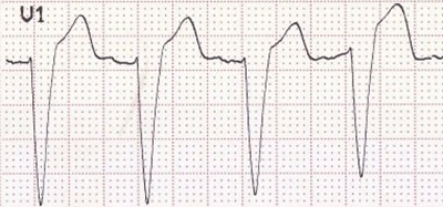 ECG (V1) LBBB, rS morphology, tiny R, deep S wave, appropriate discordance (ST elevation, upright T wave)