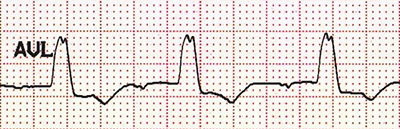 ECG (aVL) LBBB, RSR M-shaped QRS complex morphology, notched R wave