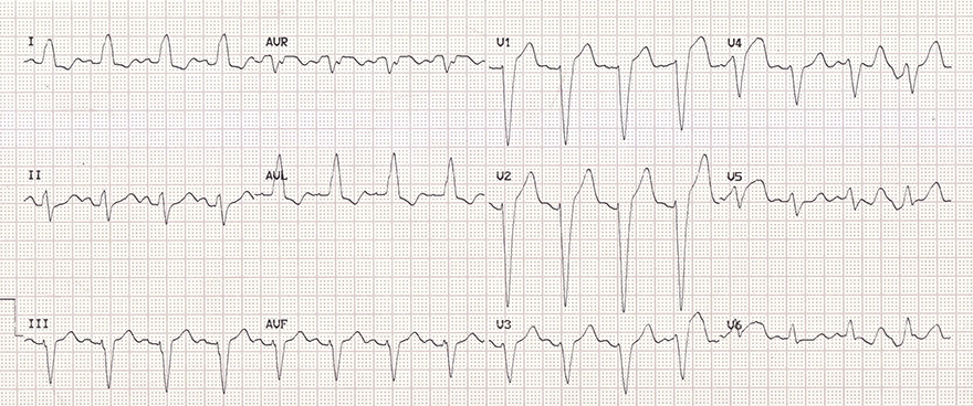 ECG LBBB, broad QRS, Dominant S wave, Absence lateral Q wave, appropriate discordance