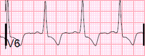 ECG incomplete Left Bundle Branch Block (LBBB)