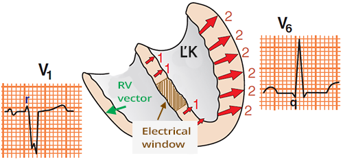 ECG lateral lead, septal old infarction with LBBB and Q wave in lateral lead