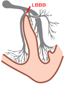 Heart electrical conduction system, left bundle branch block (LBBB)
