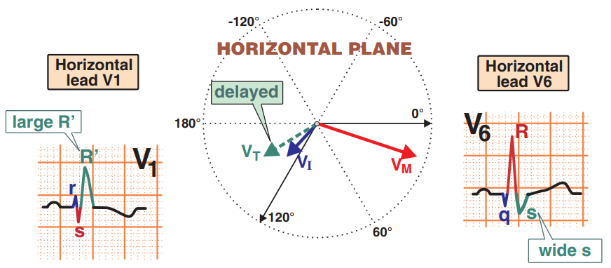 Horizontal plane, RBBB vectors, Large R (V1), Wide S (V6)