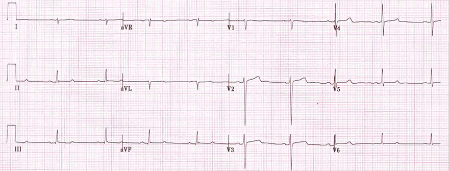 ECG Left Posterior Fascicular Block (LPFB), right axis deviation