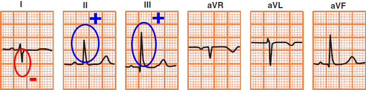 ECG left posterior Fascicular Block, Right axis deviation, QRS duration normal or slightly prolonged