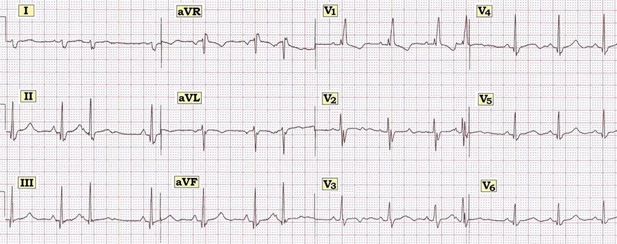 ECG bifascicular block, Right Bundle Branch Block (RBBB), Left Posterior Fascicular Block (LPFB)