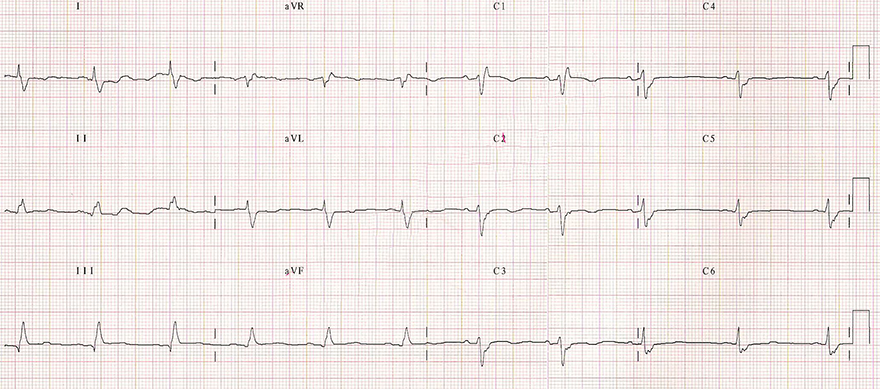 ECG bifascicular block (RBBB + LPFB)
