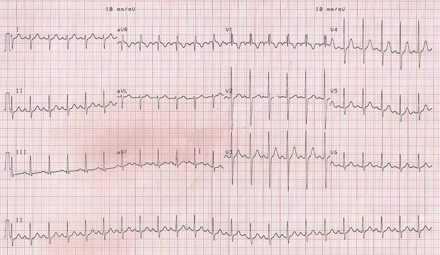 ECG Bifascicular block, incomplete Right Bundle Branch Block (RBBB), Left Posterior Fascicular Block (LPFB)