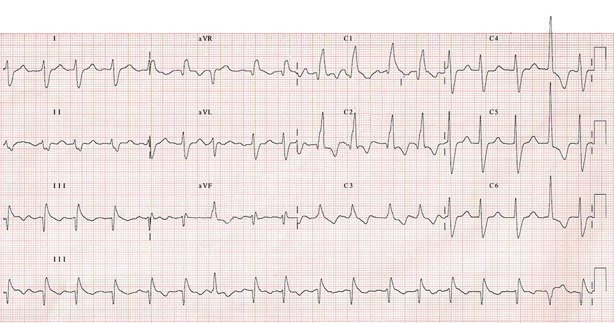 ECG bifascicular block, LPH - extreme right axis deviation, RBBB