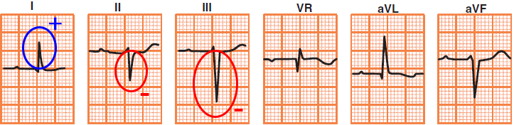 ECG left anterior fascicular block (LAFB)