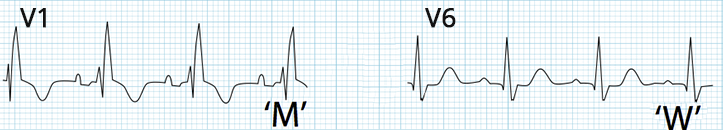 ECG complete Right Bundle Branch Block (RBBB)