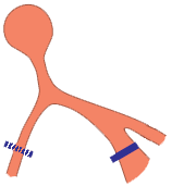 Bifascicular Block, Incomplete Right Bundle Branch Block (iRBBB), Left Posterior Fascicular Block (LPFB)