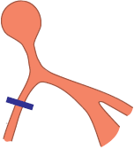 Right Bundle Branch Block (RBBB)