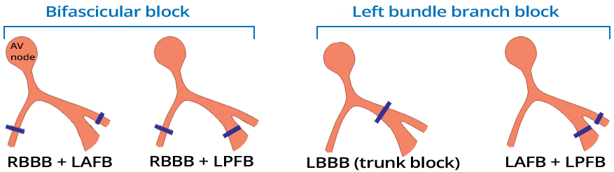 Bifascicular block (RBBB, LPH, LAH), LBBB