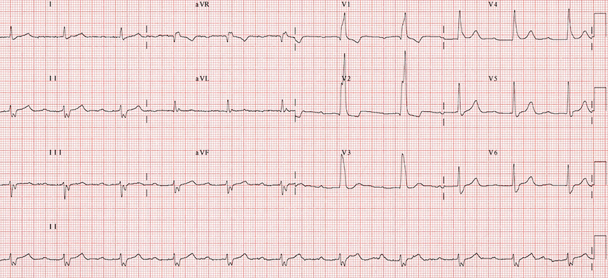 ECG Trifascicular block (Bifascicular block + 1st degree AV block)