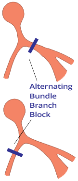 Trifascicular block, alternating RBBB and LBBB