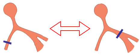 Trifascicular block, Alternating RBBB and LBBB
