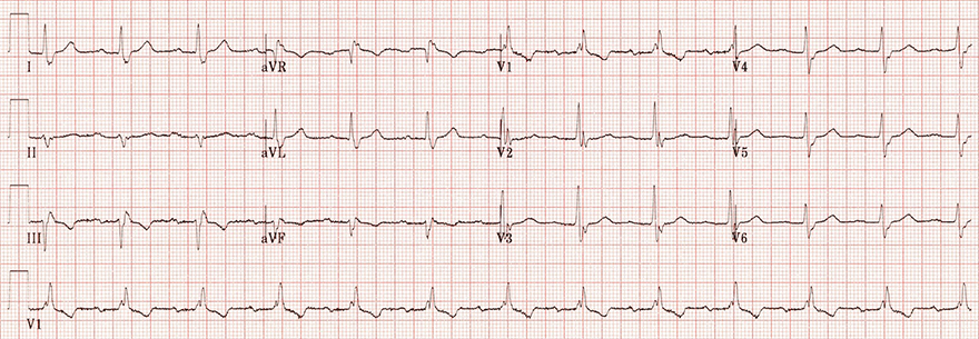 ECG Trifascicular block (Bifascicular block + 1st degree AV block)