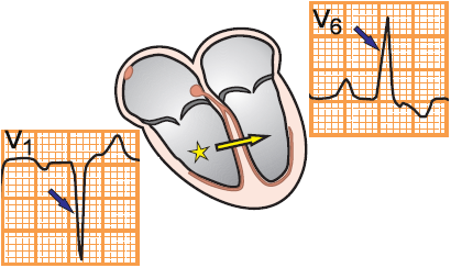 ecg V1, V6 ectopic ventricular focus, lbbb pattern