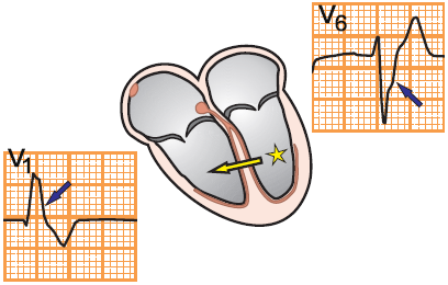 ecg V1, V6 ectopic ventricular focus, rbbb pattern