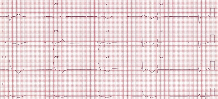 ecg idio-venricular escape rhythm, complete 3rd degree av block, av dissociation