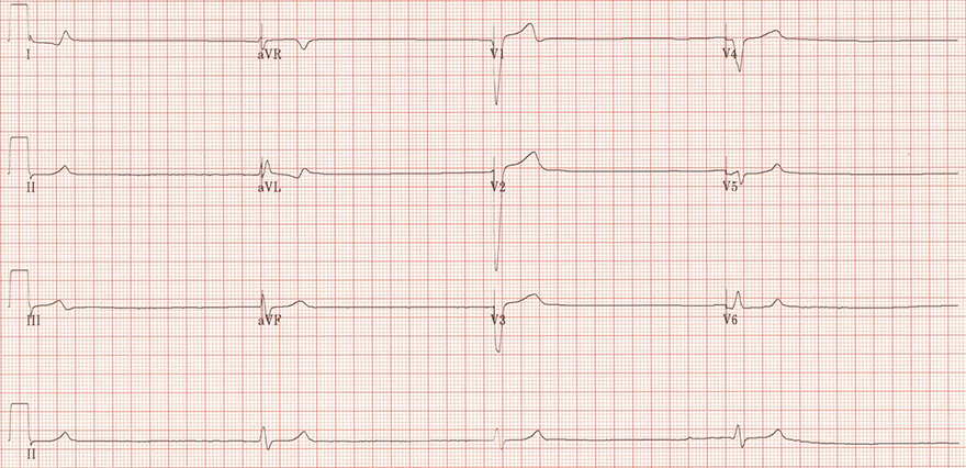 ECG idio-ventricular escape rhythm, and sinus pause