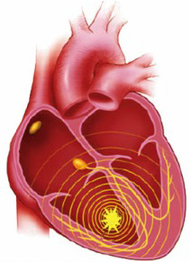 Ventricular, idioventricular escape rhythm