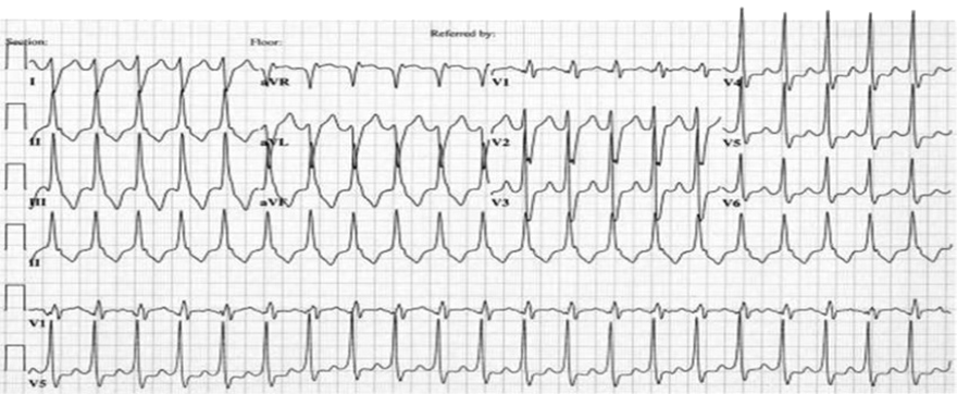 LVOT Ventricular Tachycardia ECG Book LVOT Ventricular Tachycardia ECG Book