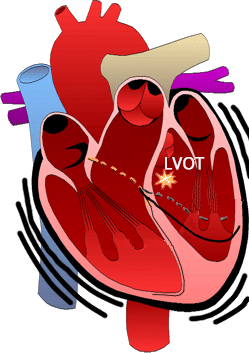 Left ventricular outflow tract tachycardia (LVOT-VT), idiopathic left ventricular tachycardia (ILVT)
